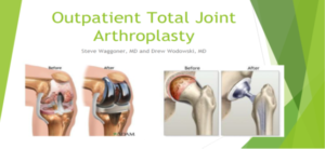 Joint Arthroplasty OrthoSouth