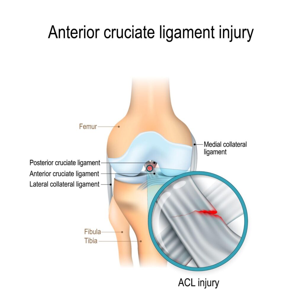 Long term symptoms of ACL tear (without surgery)